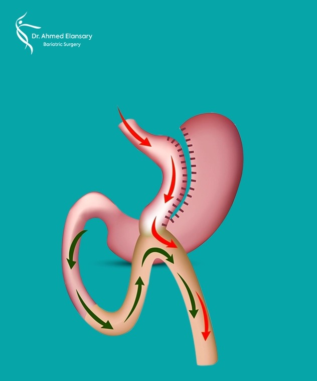 Laparoscopic Gastric Bypass