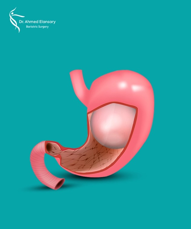 Gastric Balloon