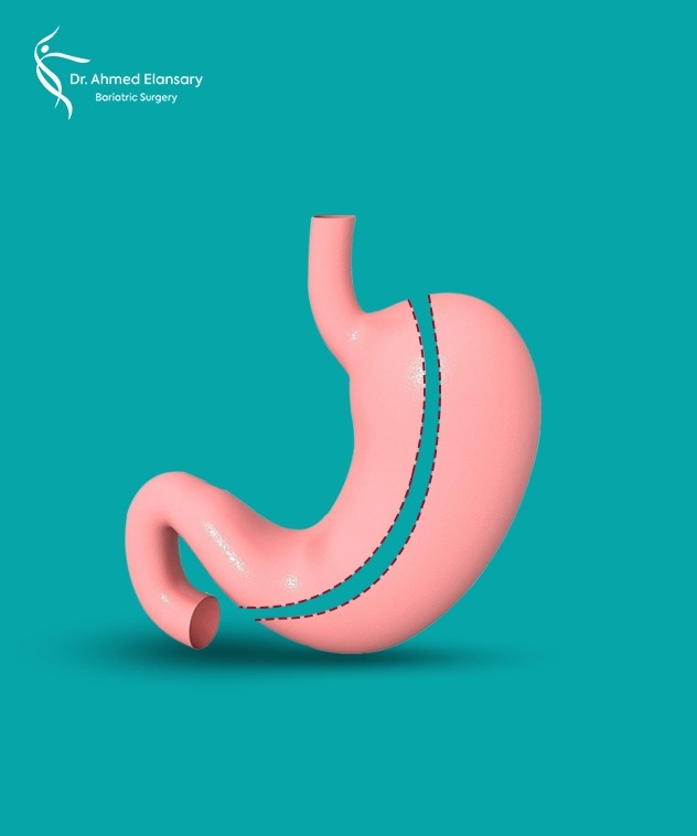 Laparoscopic Gastric Sleeve