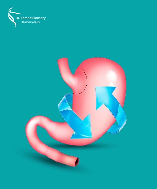 Redo Bariatric Surgery