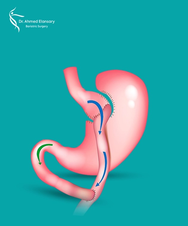 Gastric Bypass (SADI-S) 